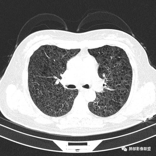 影像PPT - 【病例】中年女性,探秘双肺弥漫性囊腔-61 影像PPT - 【病例】中年女性,探秘双肺弥漫性囊腔-61