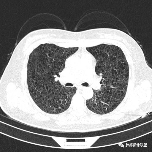 影像PPT - 【病例】中年女性,探秘双肺弥漫性囊腔-63 影像PPT - 【病例】中年女性,探秘双肺弥漫性囊腔-63
