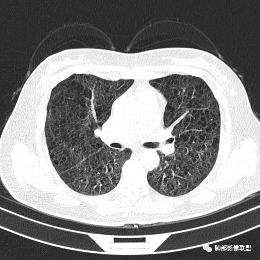 影像PPT - 【病例】中年女性,探秘双肺弥漫性囊腔-67 影像PPT - 【病例】中年女性,探秘双肺弥漫性囊腔-67