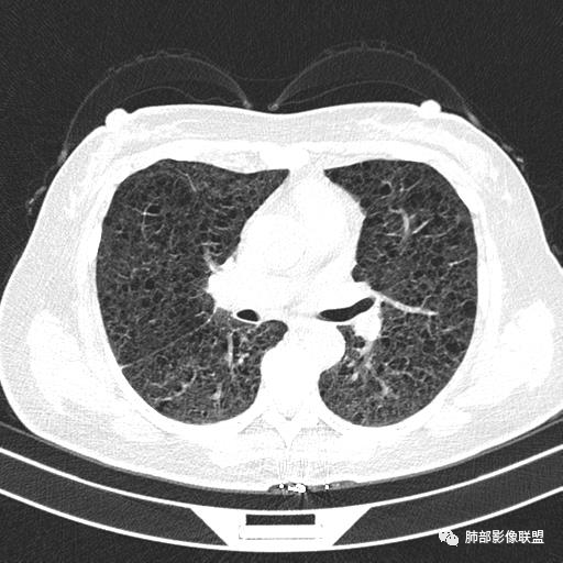影像PPT - 【病例】中年女性,探秘双肺弥漫性囊腔-71 影像PPT - 【病例】中年女性,探秘双肺弥漫性囊腔-71