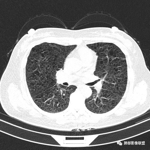 影像PPT - 【病例】中年女性,探秘双肺弥漫性囊腔-73 影像PPT - 【病例】中年女性,探秘双肺弥漫性囊腔-73