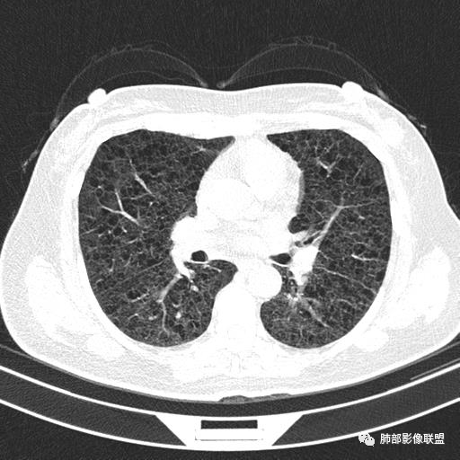 影像PPT - 【病例】中年女性,探秘双肺弥漫性囊腔-76 影像PPT - 【病例】中年女性,探秘双肺弥漫性囊腔-76