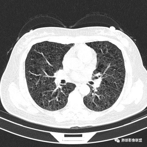 影像PPT - 【病例】中年女性,探秘双肺弥漫性囊腔-78 影像PPT - 【病例】中年女性,探秘双肺弥漫性囊腔-78