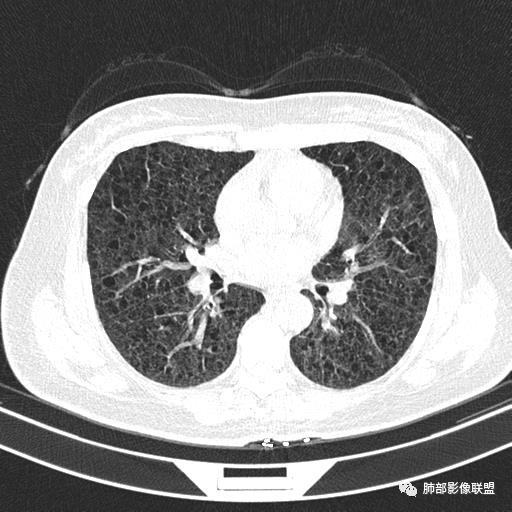 影像PPT - 【病例】中年女性,探秘双肺弥漫性囊腔-81 影像PPT - 【病例】中年女性,探秘双肺弥漫性囊腔-81