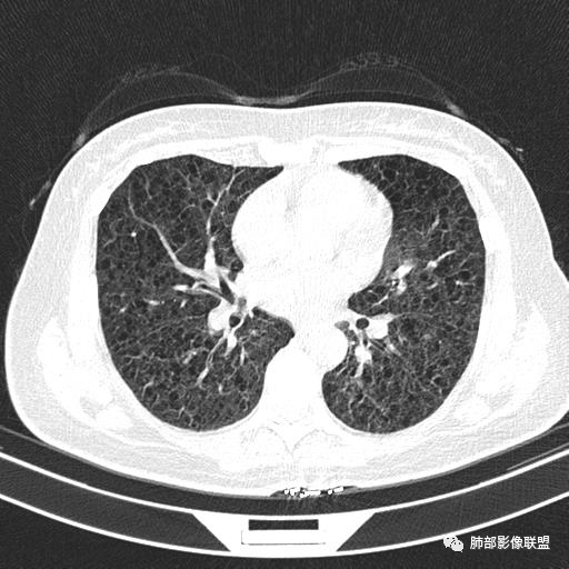 影像PPT - 【病例】中年女性,探秘双肺弥漫性囊腔-84 影像PPT - 【病例】中年女性,探秘双肺弥漫性囊腔-84