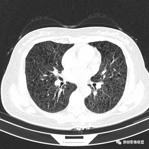 影像PPT - 【病例】中年女性,探秘双肺弥漫性囊腔-83 影像PPT - 【病例】中年女性,探秘双肺弥漫性囊腔-83