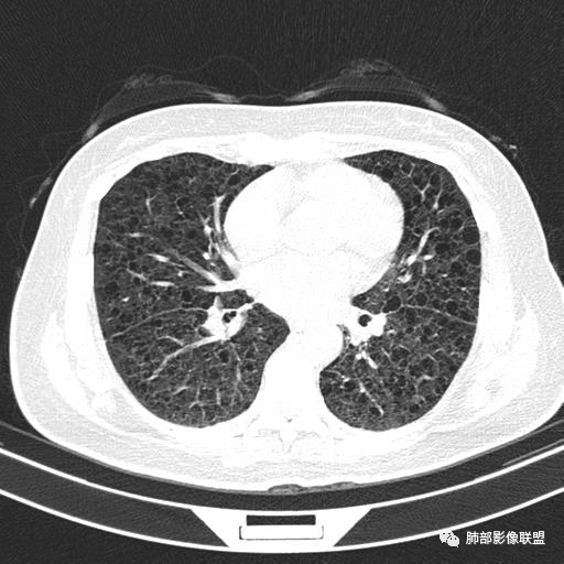 影像PPT - 【病例】中年女性,探秘双肺弥漫性囊腔-89 影像PPT - 【病例】中年女性,探秘双肺弥漫性囊腔-89
