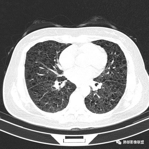 影像PPT - 【病例】中年女性,探秘双肺弥漫性囊腔-90 影像PPT - 【病例】中年女性,探秘双肺弥漫性囊腔-90