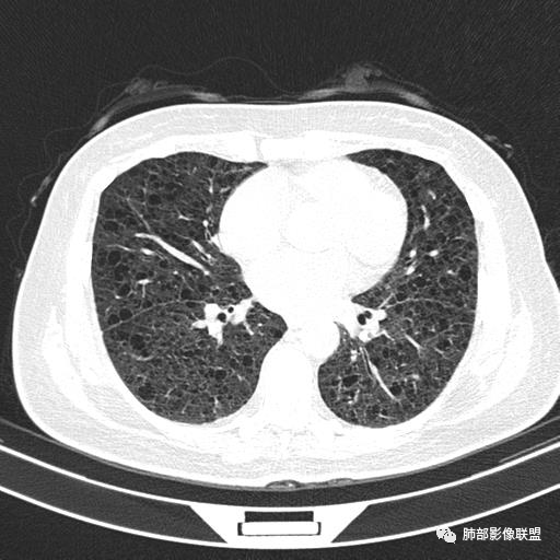 影像PPT - 【病例】中年女性,探秘双肺弥漫性囊腔-92 影像PPT - 【病例】中年女性,探秘双肺弥漫性囊腔-92