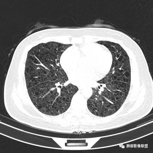 影像PPT - 【病例】中年女性,探秘双肺弥漫性囊腔-94 影像PPT - 【病例】中年女性,探秘双肺弥漫性囊腔-94