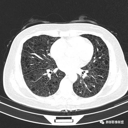 影像PPT - 【病例】中年女性,探秘双肺弥漫性囊腔-93 影像PPT - 【病例】中年女性,探秘双肺弥漫性囊腔-93