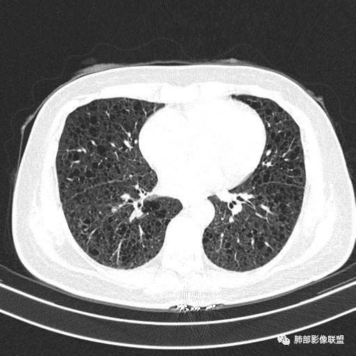 影像PPT - 【病例】中年女性,探秘双肺弥漫性囊腔-98 影像PPT - 【病例】中年女性,探秘双肺弥漫性囊腔-98