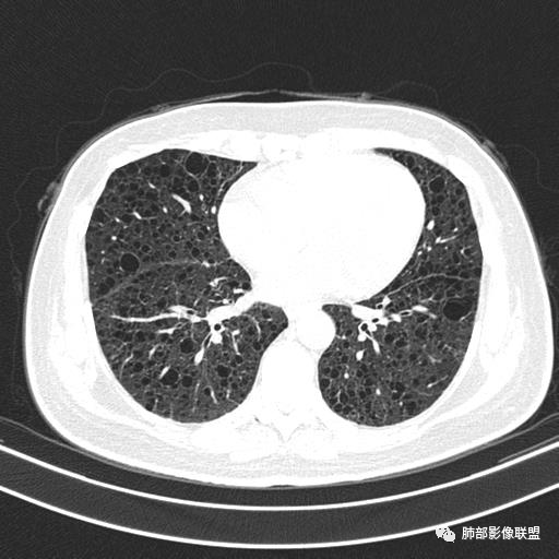 影像PPT - 【病例】中年女性,探秘双肺弥漫性囊腔-104 影像PPT - 【病例】中年女性,探秘双肺弥漫性囊腔-104
