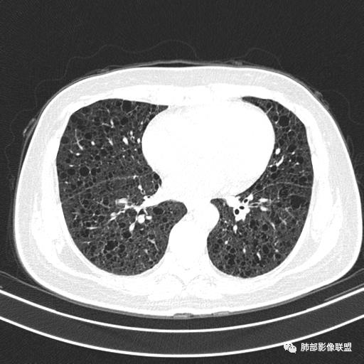 影像PPT - 【病例】中年女性,探秘双肺弥漫性囊腔-101 影像PPT - 【病例】中年女性,探秘双肺弥漫性囊腔-101