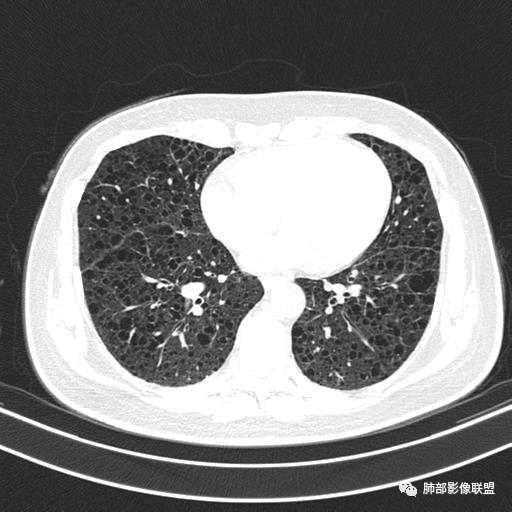 影像PPT - 【病例】中年女性,探秘双肺弥漫性囊腔-107 影像PPT - 【病例】中年女性,探秘双肺弥漫性囊腔-107