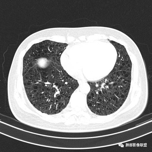 影像PPT - 【病例】中年女性,探秘双肺弥漫性囊腔-112 影像PPT - 【病例】中年女性,探秘双肺弥漫性囊腔-112
