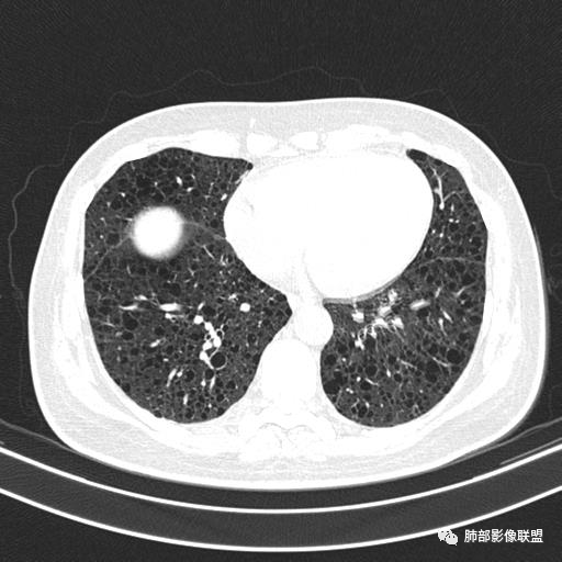 影像PPT - 【病例】中年女性,探秘双肺弥漫性囊腔-113 影像PPT - 【病例】中年女性,探秘双肺弥漫性囊腔-113