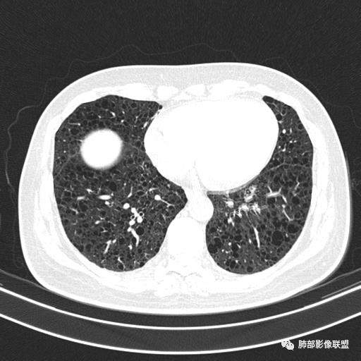 影像PPT - 【病例】中年女性,探秘双肺弥漫性囊腔-114 影像PPT - 【病例】中年女性,探秘双肺弥漫性囊腔-114