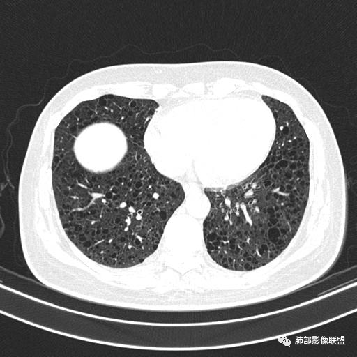 影像PPT - 【病例】中年女性,探秘双肺弥漫性囊腔-116 影像PPT - 【病例】中年女性,探秘双肺弥漫性囊腔-116