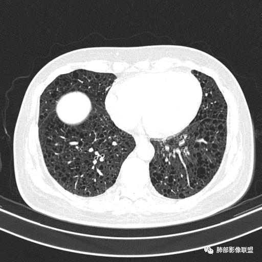 影像PPT - 【病例】中年女性,探秘双肺弥漫性囊腔-115 影像PPT - 【病例】中年女性,探秘双肺弥漫性囊腔-115