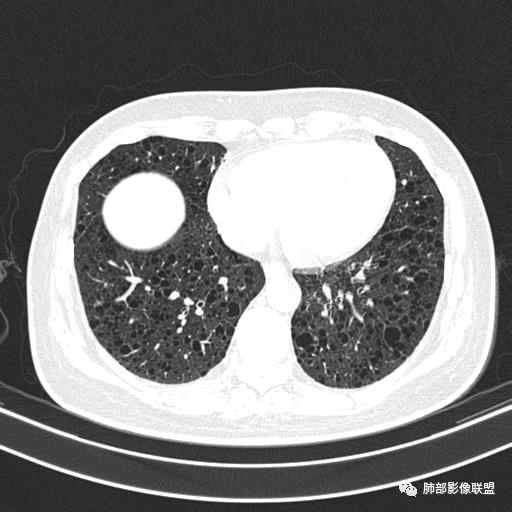 影像PPT - 【病例】中年女性,探秘双肺弥漫性囊腔-117 影像PPT - 【病例】中年女性,探秘双肺弥漫性囊腔-117