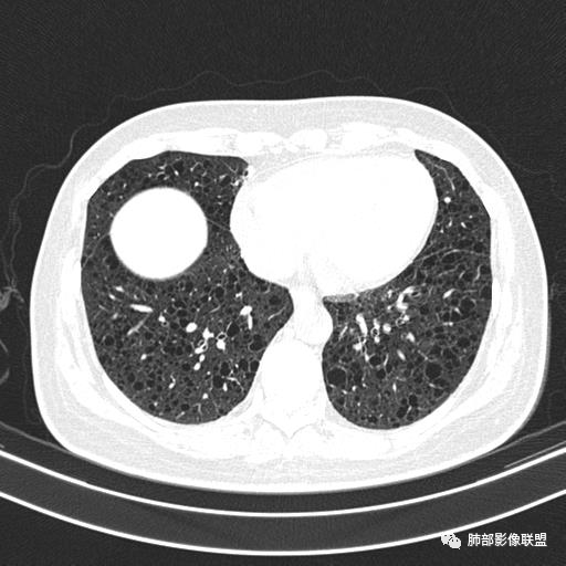 影像PPT - 【病例】中年女性,探秘双肺弥漫性囊腔-118 影像PPT - 【病例】中年女性,探秘双肺弥漫性囊腔-118