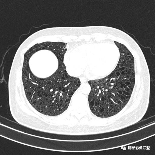 影像PPT - 【病例】中年女性,探秘双肺弥漫性囊腔-120 影像PPT - 【病例】中年女性,探秘双肺弥漫性囊腔-120