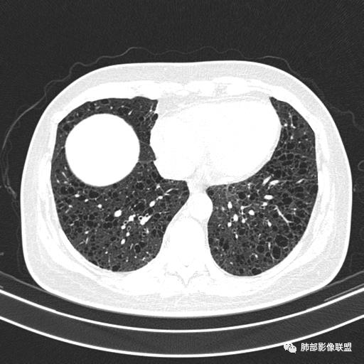 影像PPT - 【病例】中年女性,探秘双肺弥漫性囊腔-122 影像PPT - 【病例】中年女性,探秘双肺弥漫性囊腔-122