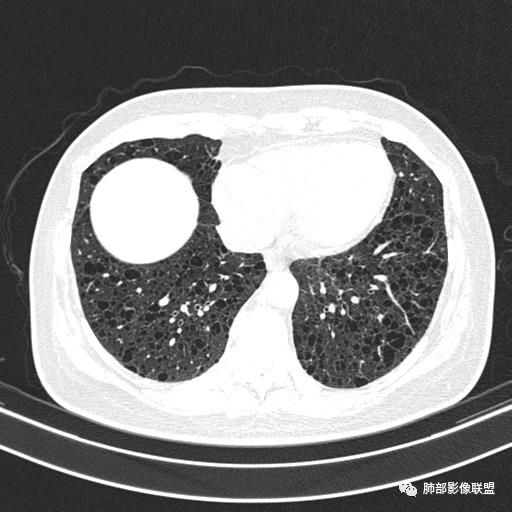 影像PPT - 【病例】中年女性,探秘双肺弥漫性囊腔-123 影像PPT - 【病例】中年女性,探秘双肺弥漫性囊腔-123