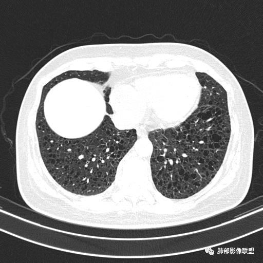 影像PPT - 【病例】中年女性,探秘双肺弥漫性囊腔-126 影像PPT - 【病例】中年女性,探秘双肺弥漫性囊腔-126