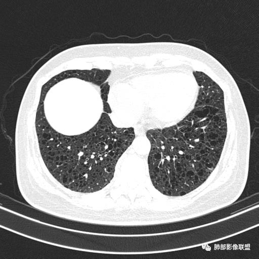 影像PPT - 【病例】中年女性,探秘双肺弥漫性囊腔-125 影像PPT - 【病例】中年女性,探秘双肺弥漫性囊腔-125