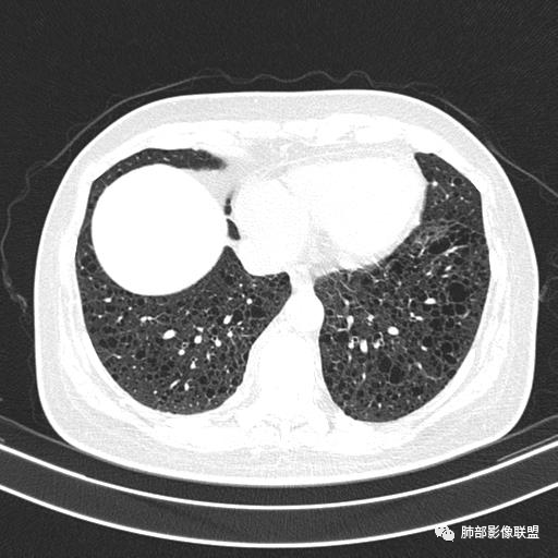 影像PPT - 【病例】中年女性,探秘双肺弥漫性囊腔-127 影像PPT - 【病例】中年女性,探秘双肺弥漫性囊腔-127