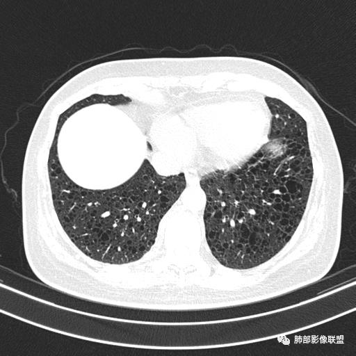 影像PPT - 【病例】中年女性,探秘双肺弥漫性囊腔-128 影像PPT - 【病例】中年女性,探秘双肺弥漫性囊腔-128