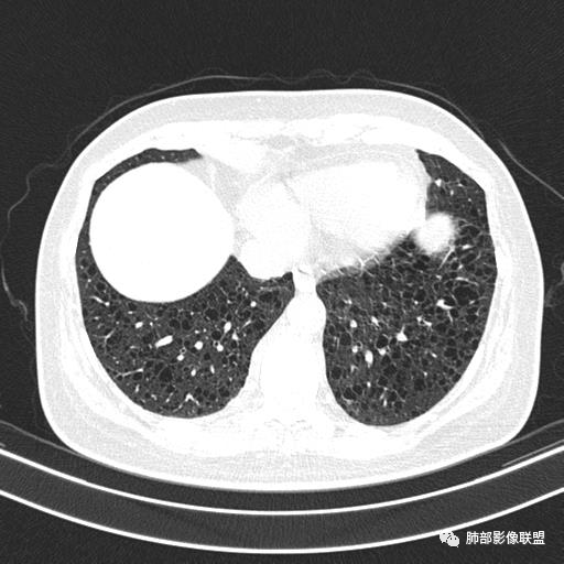影像PPT - 【病例】中年女性,探秘双肺弥漫性囊腔-129 影像PPT - 【病例】中年女性,探秘双肺弥漫性囊腔-129