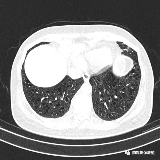 影像PPT - 【病例】中年女性,探秘双肺弥漫性囊腔-132 影像PPT - 【病例】中年女性,探秘双肺弥漫性囊腔-132