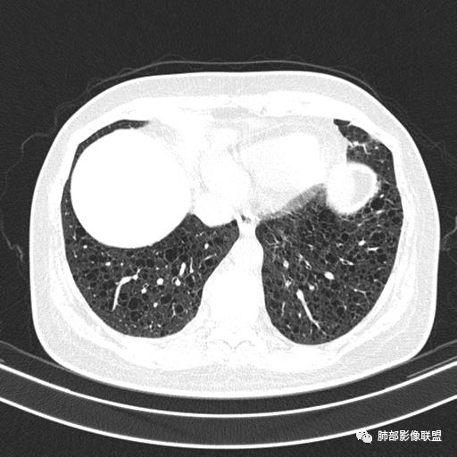 影像PPT - 【病例】中年女性,探秘双肺弥漫性囊腔-131 影像PPT - 【病例】中年女性,探秘双肺弥漫性囊腔-131