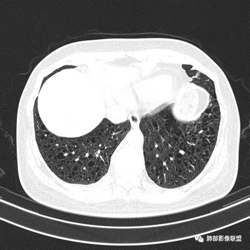 影像PPT - 【病例】中年女性,探秘双肺弥漫性囊腔-133 影像PPT - 【病例】中年女性,探秘双肺弥漫性囊腔-133