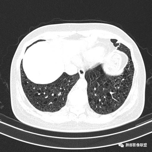 影像PPT - 【病例】中年女性,探秘双肺弥漫性囊腔-134 影像PPT - 【病例】中年女性,探秘双肺弥漫性囊腔-134