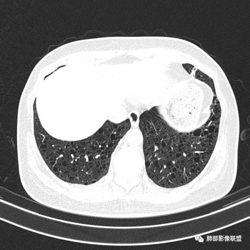 影像PPT - 【病例】中年女性,探秘双肺弥漫性囊腔-137 影像PPT - 【病例】中年女性,探秘双肺弥漫性囊腔-137