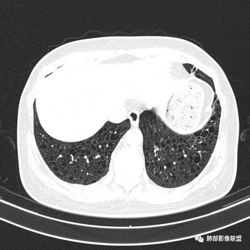 影像PPT - 【病例】中年女性,探秘双肺弥漫性囊腔-138 影像PPT - 【病例】中年女性,探秘双肺弥漫性囊腔-138