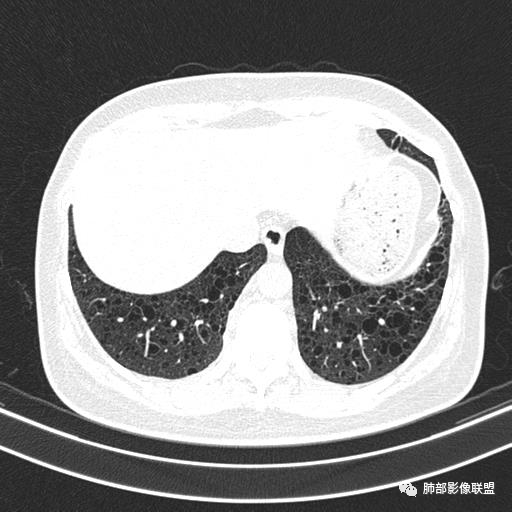 影像PPT - 【病例】中年女性,探秘双肺弥漫性囊腔-140 影像PPT - 【病例】中年女性,探秘双肺弥漫性囊腔-140