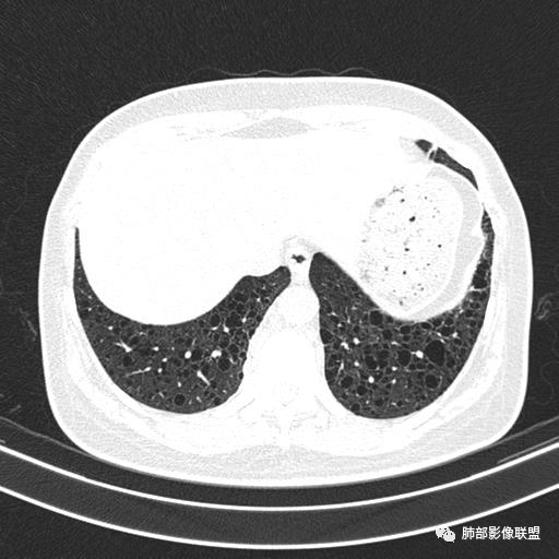 影像PPT - 【病例】中年女性,探秘双肺弥漫性囊腔-142 影像PPT - 【病例】中年女性,探秘双肺弥漫性囊腔-142