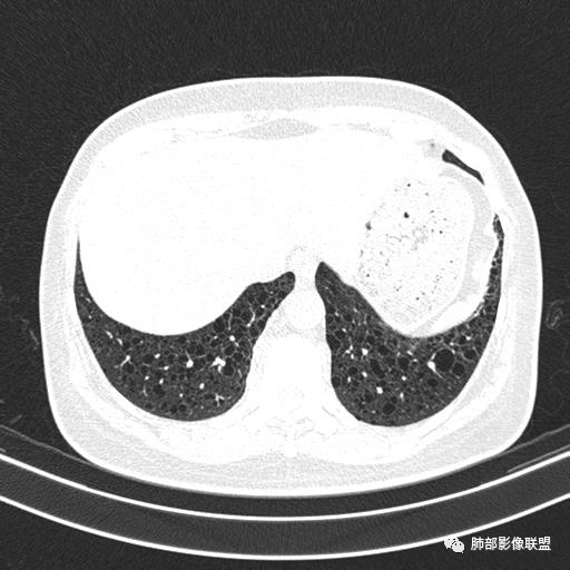 影像PPT - 【病例】中年女性,探秘双肺弥漫性囊腔-144 影像PPT - 【病例】中年女性,探秘双肺弥漫性囊腔-144