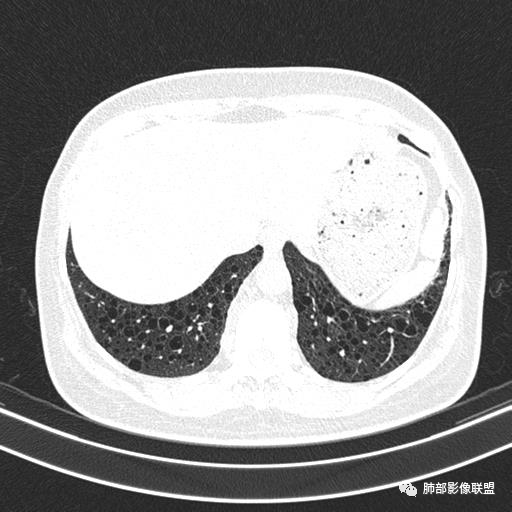 影像PPT - 【病例】中年女性,探秘双肺弥漫性囊腔-146 影像PPT - 【病例】中年女性,探秘双肺弥漫性囊腔-146