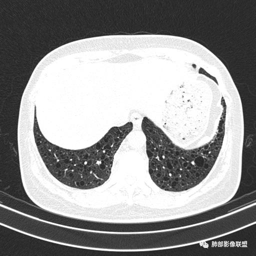 影像PPT - 【病例】中年女性,探秘双肺弥漫性囊腔-143 影像PPT - 【病例】中年女性,探秘双肺弥漫性囊腔-143