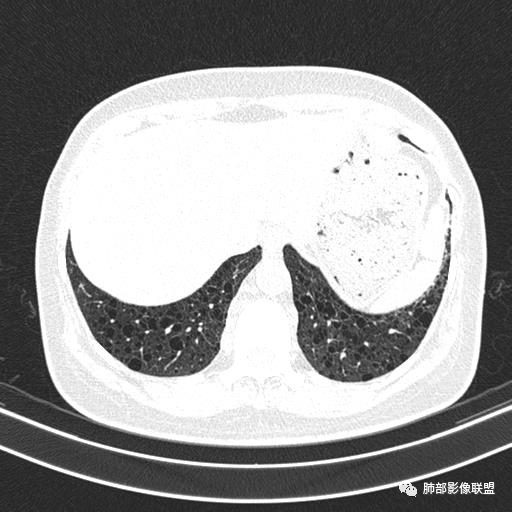 影像PPT - 【病例】中年女性,探秘双肺弥漫性囊腔-147 影像PPT - 【病例】中年女性,探秘双肺弥漫性囊腔-147