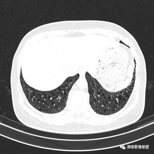 影像PPT - 【病例】中年女性,探秘双肺弥漫性囊腔-145 影像PPT - 【病例】中年女性,探秘双肺弥漫性囊腔-145