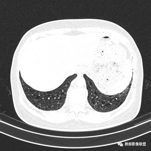 影像PPT - 【病例】中年女性,探秘双肺弥漫性囊腔-150 影像PPT - 【病例】中年女性,探秘双肺弥漫性囊腔-150