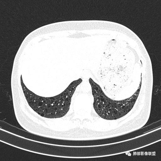 影像PPT - 【病例】中年女性,探秘双肺弥漫性囊腔-149 影像PPT - 【病例】中年女性,探秘双肺弥漫性囊腔-149