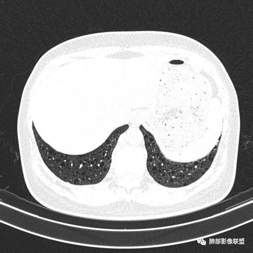 影像PPT - 【病例】中年女性,探秘双肺弥漫性囊腔-152 影像PPT - 【病例】中年女性,探秘双肺弥漫性囊腔-152